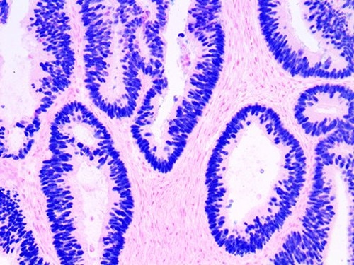 IHC of SATB2 on an FFPE Colon Carcinoma Tissue